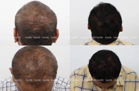 What Your Hair Says About Your Nutritional Deficiency